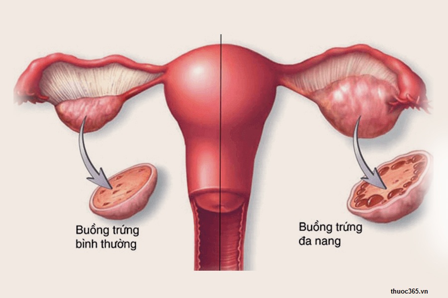 Hình ảnh 3: Thuốc profertil sử dụng cho bệnh nhân buồng trứng đa nang